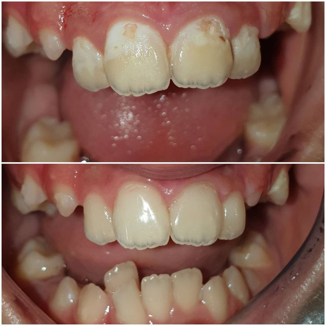 Daimi Diş Dolguları