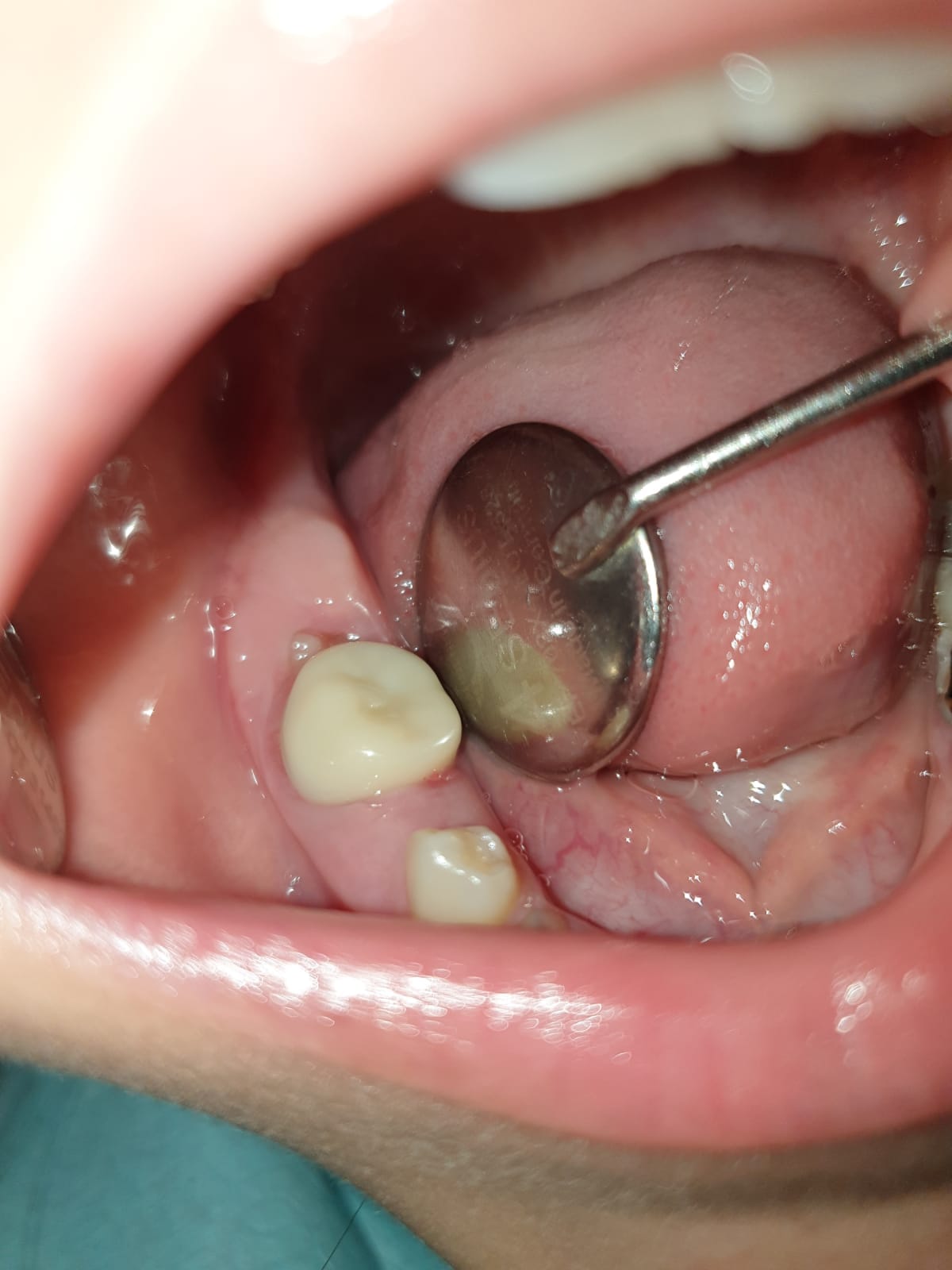 Daimi Prefabrik Zirkon Kaplamalar