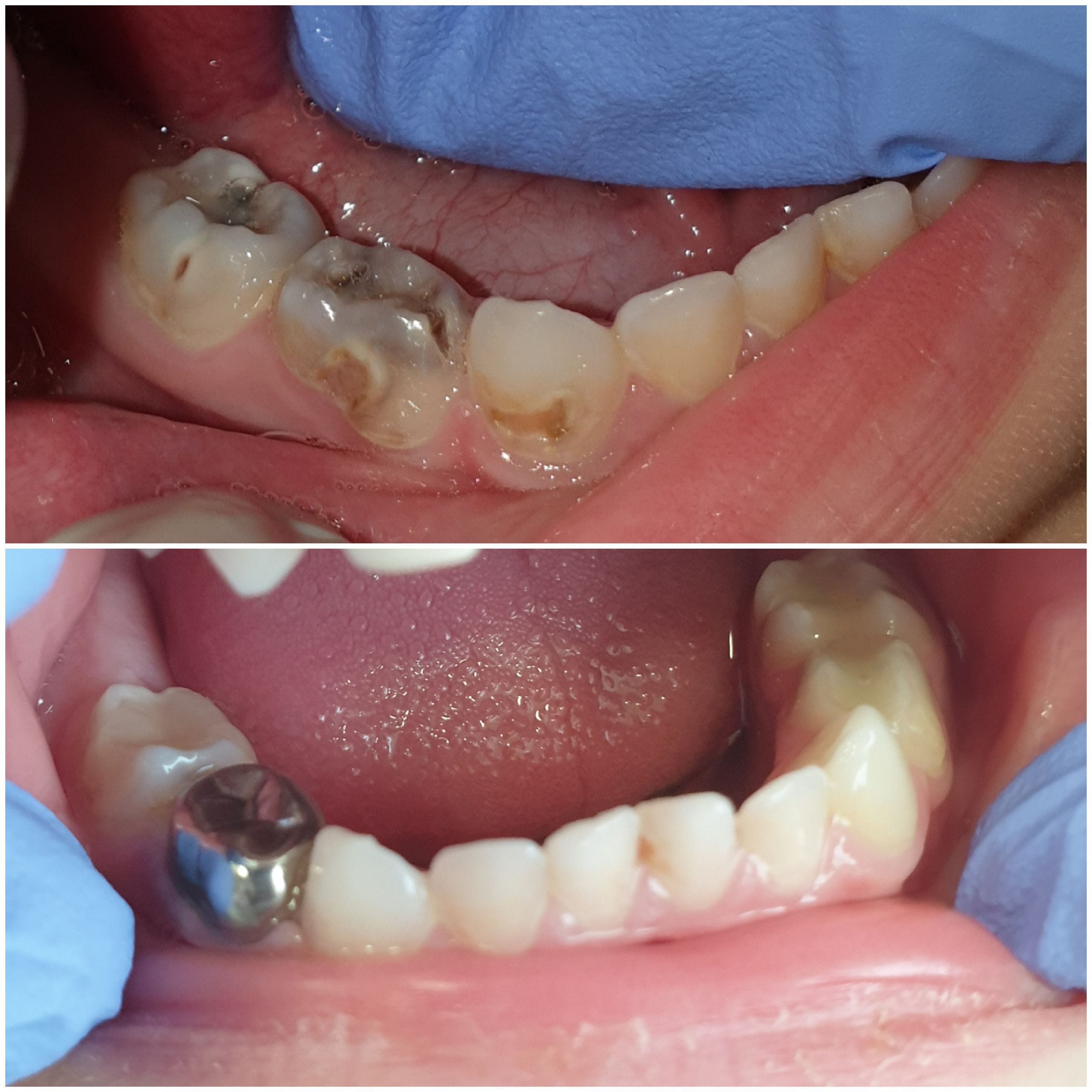 Paslanmaz Çelik Kronlar