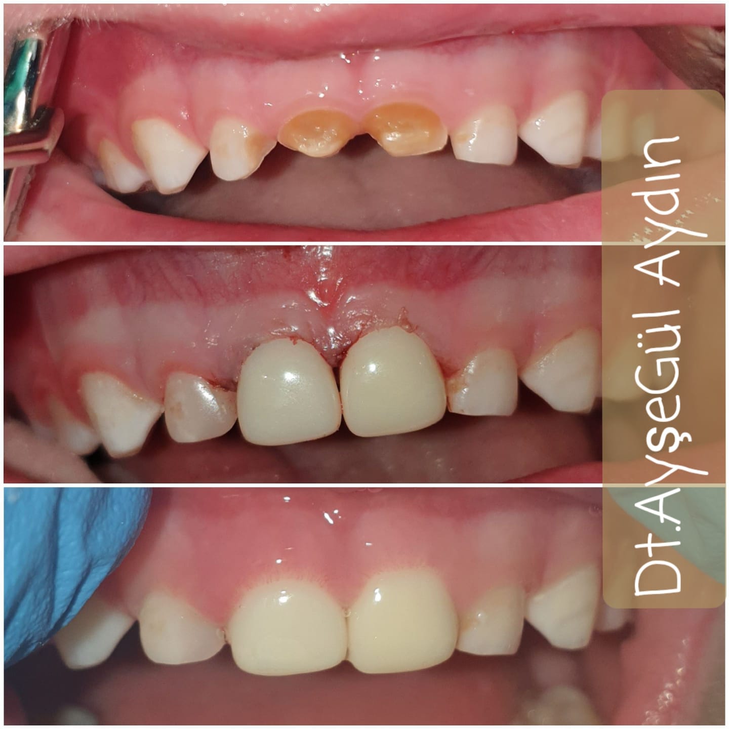 Pediatrik Zirkonyum Kronlar